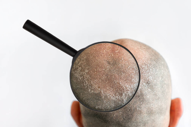 Man's bald flaky head with dandruff and zoomed with magnifier problem area, back view. White background. The concept of psoriasis, sunburn and seborrheic dermatitis. - Photo, Image