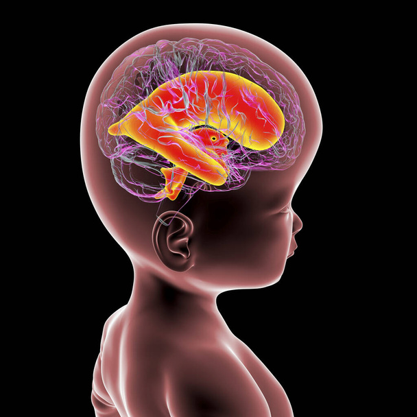 Makrosefali ve genişlemiş beyin ventrikülleri olan bir bebeğin 3 boyutlu bilimsel çizimi, anormal beyin büyümesiyle ilişkili bir durum.. - Fotoğraf, Görsel