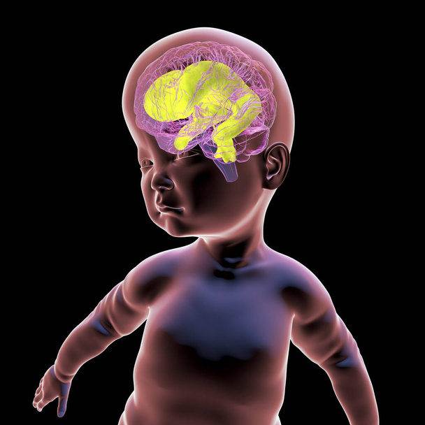 Illustration 3D scientifique d'un bébé présentant une macrocéphalie et des ventricules cérébraux élargis, une condition associée à une croissance anormale du cerveau. - Photo, image