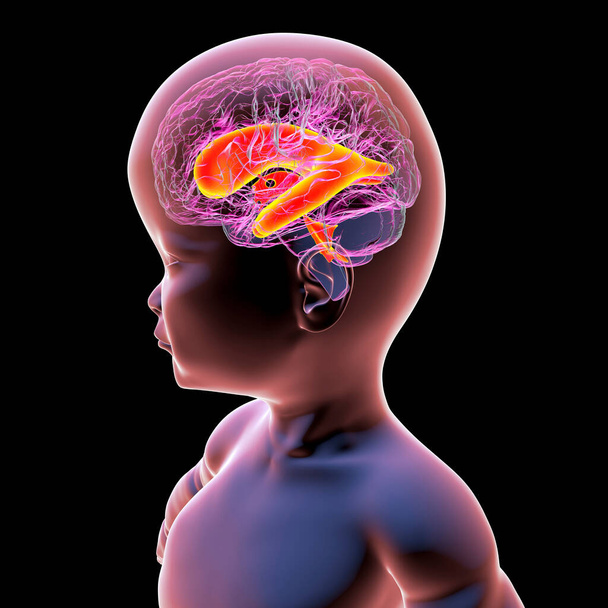 Научная 3D иллюстрация ребенка с макроцефалией и увеличенными боковыми желудочками, состояние, связанное с аномальным ростом мозга. - Фото, изображение