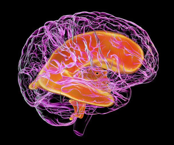 子供の脳の拡大された中心を描いた3D科学的イラスト(ヒドロスファロス)). - 写真・画像