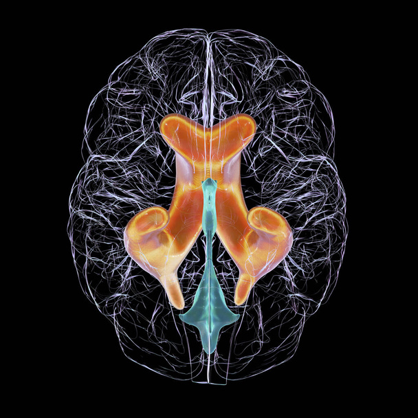 Una ilustración científica en 3D que representa ventrículos laterales agrandados del cerebro (hidrocefalia), vista inferior. - Foto, imagen