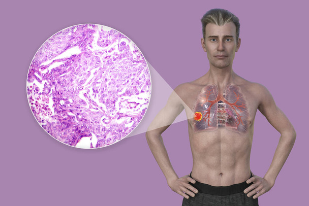 Un uomo con cancro ai polmoni, illustrazione 3D, insieme a un'immagine micrografica di adenocarcinoma polmonare. - Foto, immagini