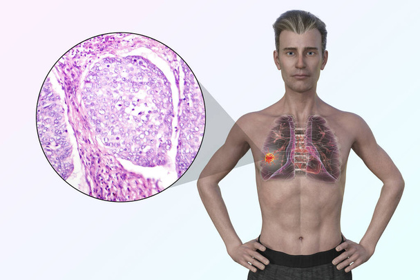 Een man met longkanker, 3D illustratie, samen met een micrograaf afbeelding van longadenocarcinoom. - Foto, afbeelding