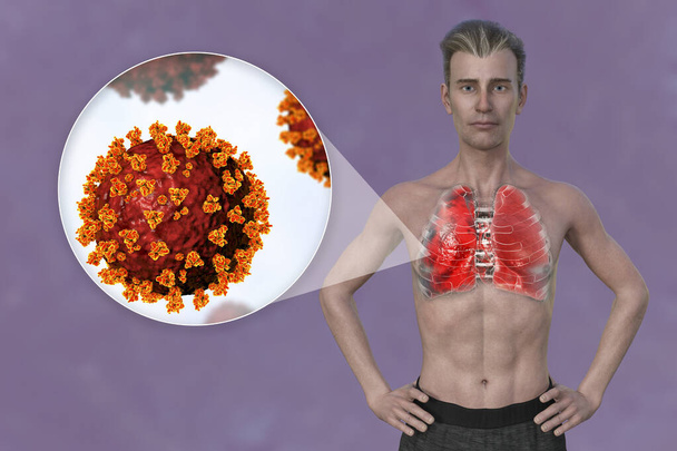Şeffaf derili bir adamın üst yarısını gösteren 3 boyutlu fotorealistik bir illüstrasyon Covid-19 zatürreesinden etkilenen akciğerleri ve SARS-CoV-2 virüslerinin yakın çekim görüntülerini ortaya çıkarıyor.. - Fotoğraf, Görsel