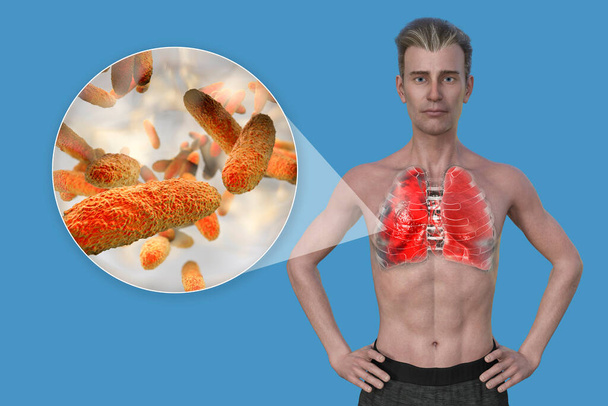 Un'illustrazione fotorealistica 3D che mostra la metà superiore di un uomo con pelle trasparente, rivelando i polmoni affetti da polmonite e la visione ravvicinata dei batteri Klebsiella pneumoniae. - Foto, immagini