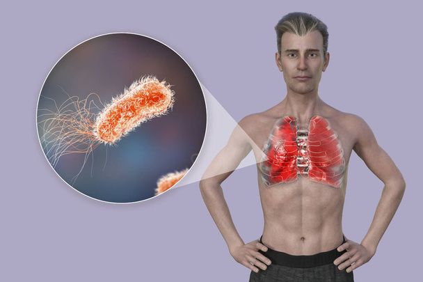 Een 3D fotorealistische illustratie van de bovenste helft van een man met transparante huid, onthullen de longen getroffen door longontsteking, en close-up zicht van Pseudomonas aeruginosa bacteriën. - Foto, afbeelding