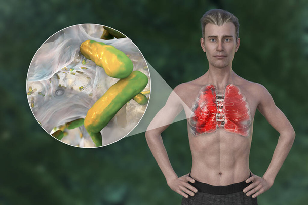 Μια τρισδιάστατη φωτορεαλιστική απεικόνιση που δείχνει το άνω μισό ενός άνδρα με διαφανές δέρμα, αποκαλύπτοντας τους πνεύμονες που έχουν προσβληθεί από πνευμονία, και κοντινή προβολή των βακτηρίων Pseudomonas aeruginosa. - Φωτογραφία, εικόνα