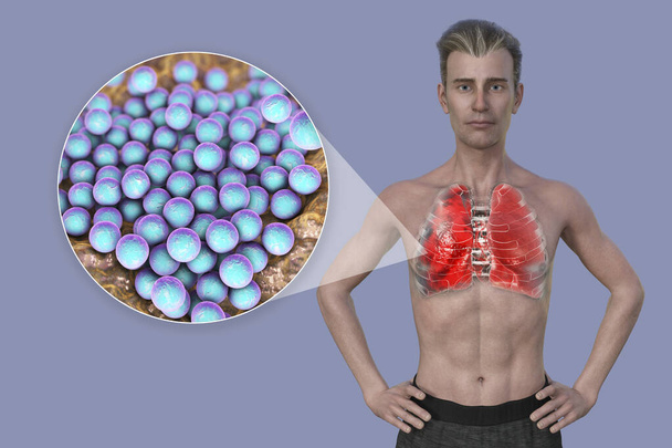 Μια τρισδιάστατη φωτορεαλιστική απεικόνιση που δείχνει το άνω μισό μέρος ενός άνδρα με διαφανές δέρμα, αποκαλύπτοντας τους πνεύμονες που έχουν προσβληθεί από πνευμονία, και κοντινή προβολή των βακτηρίων Staphylococcus aureus. - Φωτογραφία, εικόνα