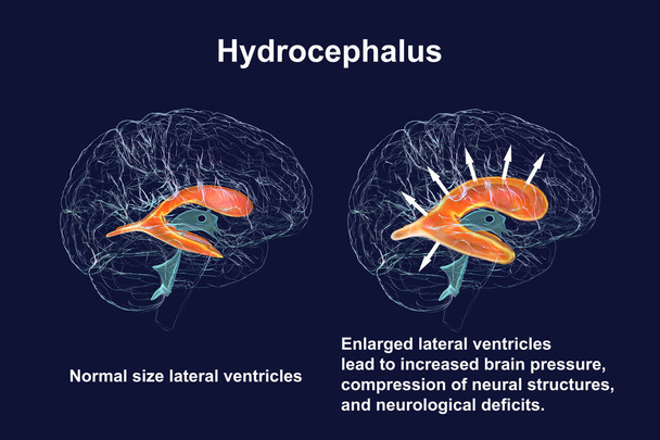 Çocuk beyninin genişlemiş yanal ventriküllerini (hidrosefalus, sağ taraf) ve normal ventriküler sistemi (sol taraf) tasvir eden üç boyutlu bilimsel bir çizim.). - Fotoğraf, Görsel