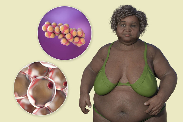 Μια τρισδιάστατη ιατρική απεικόνιση που παρουσιάζει μια υπέρβαρη γυναίκα με κοντινή θέα στα λιποκύτταρα και τα μόρια χοληστερόλης, τονίζοντας τη σχέση μεταξύ παχυσαρκίας και μεταβολισμού της χοληστερόλης.. - Φωτογραφία, εικόνα