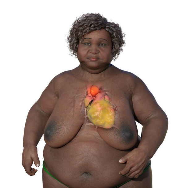 Ilustración científica en 3D que representa a una mujer obesa con piel transparente, revelando un aneurisma aórtico ascendente, un concepto que destaca la asociación del aneurisma aórtico ascendente con la obesidad. - Foto, Imagen