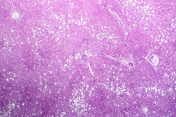 Fotomikrograf jaterní steatózy, odhalující hromadění tuku v jaterních buňkách, známé jako tukové onemocnění jater. - Fotografie, Obrázek