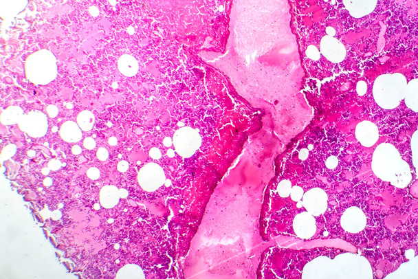 Фотомикрограф лобарной пневмонии в период геморрагического отёка, показывающий воспаление тканей лёгких с геморрагическими изменениями. - Фото, изображение