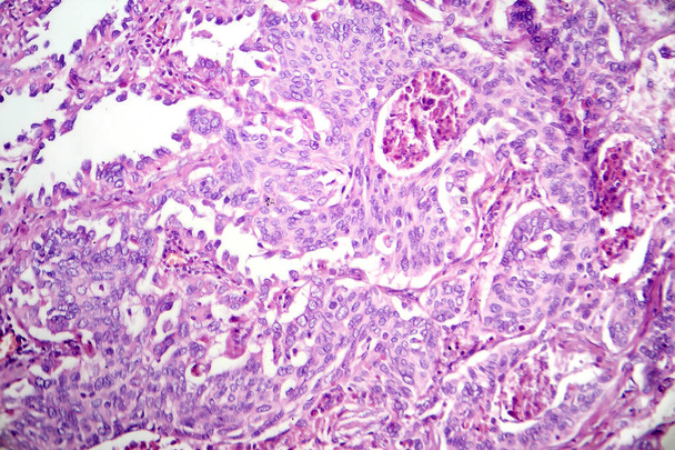 Φωτομικρογραφία του αδενοκαρκινώματος του πνεύμονα, που απεικονίζει κακοήθη αδενικά κύτταρα χαρακτηριστικά του πιο κοινού τύπου καρκίνου του πνεύμονα. - Φωτογραφία, εικόνα