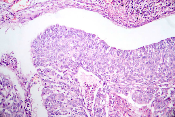 Fotomikrograf gruczolakoraka płuc, ilustrujący złośliwe komórki gruczołowe charakterystyczne dla najczęstszego typu raka płuc. - Zdjęcie, obraz