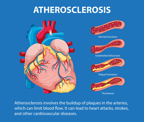Aprenda sobre la salud y la enfermedad del corazón a través de una infografía informativa - Vector, imagen