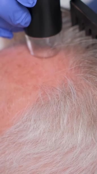 Detailní záběr trichologa, jak zkoumá staršího muže. Problém plešatosti a vypadávání vlasů. Svislé video - Záběry, video