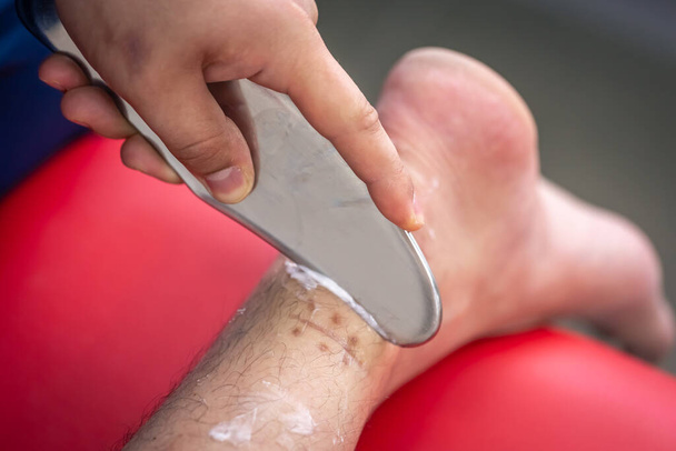 Heel and arch pain treatment with Instrument Assisted Soft Tissue Mobilization IASTM. - 写真・画像