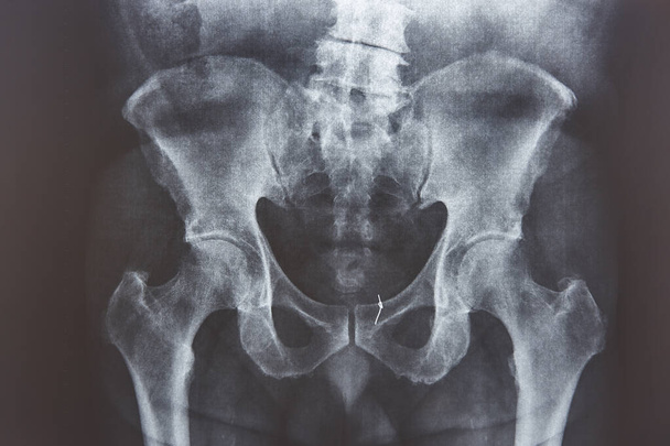 Raio-X da anca. Fio de ouro preso no osso. Exame médico - Foto, Imagem