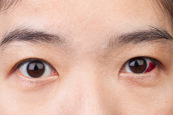 Повреждение глаз или заражение для здоровой концепции, макро крупным планом
  - Фото, изображение