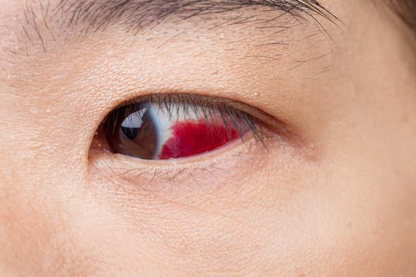 Göz yaralanması ya da sağlıklı kavramı, makro closeup enfekte  - Fotoğraf, Görsel