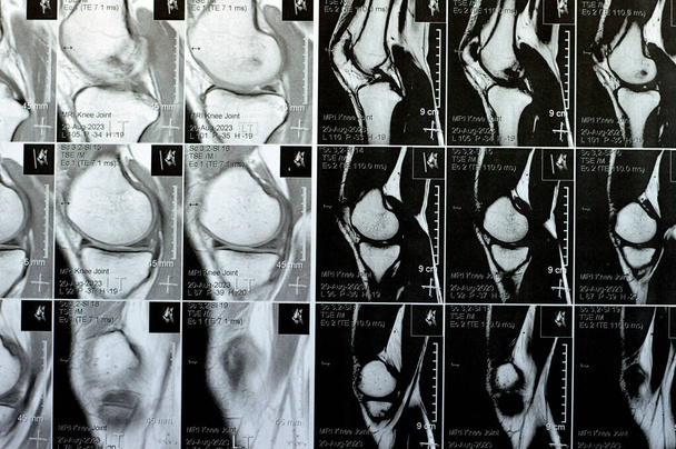 IRM de l'articulation du genou gauche montrant un épanchement articulaire minimal, PHMM Corne postérieure dégénérescence du ménisque médian, ACL ligament croisé antérieur entorse légère, normale MCL, LM, LCL, ligaments, vaisseaux et nerfs - Photo, image