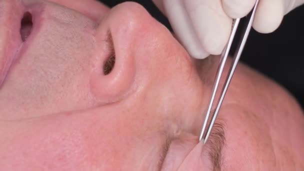 Close-up, onderzoek van het gezicht van een oude man voor plastische chirurgie om het ooggebied te veranderen. Verticale video - Video