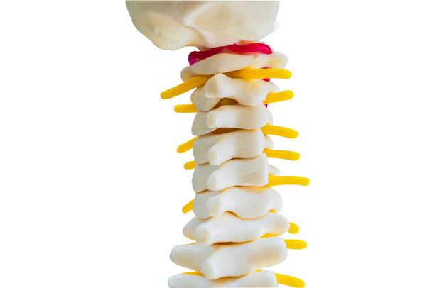 La columna lumbar desplazó el fragmento de disco herniado, el nervio espinal y el hueso. Modelo sobre fondo blanco con camino de recorte, para tratamiento médico en el departamento ortopédico. - Foto, imagen