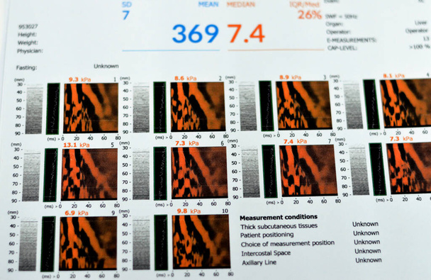 Fibroscan-Untersuchung der Leber ergab F2 bei Lebersteifheit, S3 bei Lebersteatose, Fibrose-Messung 7,4 kPa, CAP-Capture-Dämpfungsparameter 369 dBm, Ultraschallelastographie - Foto, Bild