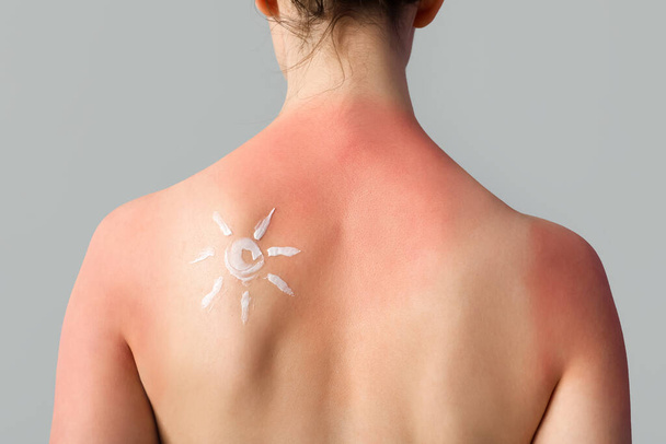 Mujer joven alérgica con piel quemada por el sol y sol hecho de crema sobre fondo gris, vista posterior - Foto, Imagen