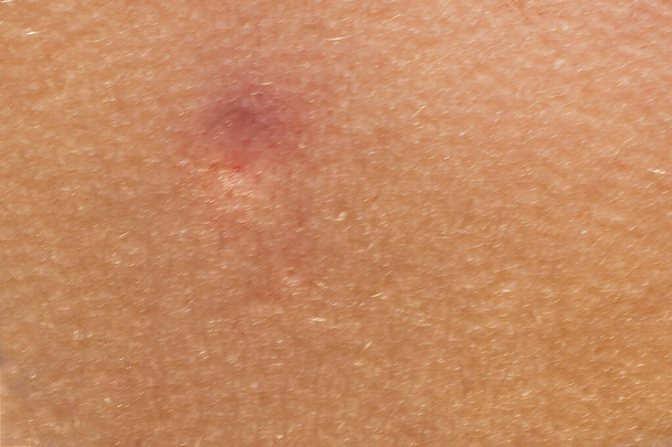 close-up de uma picada de inseto na pele. Reacção alérgica. Inflamação cutânea. Doenças e tratamento de doenças de pele - Foto, Imagem