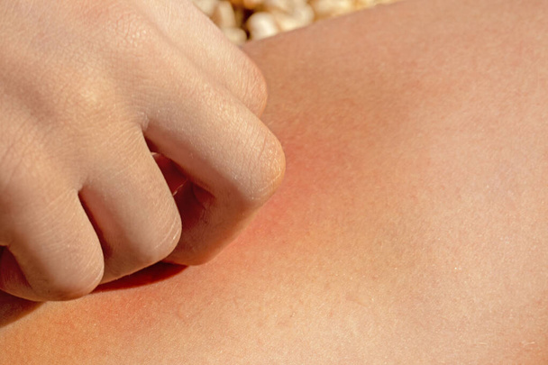 蚊に噛まれた手のクローズアップ. アレルギー性アレルギー反応および皮膚疾患 - 写真・画像