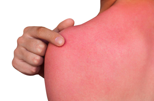 Ένας άντρας με κοκκινισμένο, φαγούρα στο δέρμα μετά το ηλιακό έγκαυμα. Φροντίδα και προστασία του δέρματος από τις υπεριώδεις ακτίνες του ήλιου. - Φωτογραφία, εικόνα