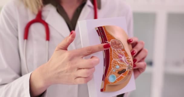 Ginecologista explica a doença das glândulas mamárias usando modelo anatômico da mama. Doenças das glândulas mamárias em mulheres - Filmagem, Vídeo