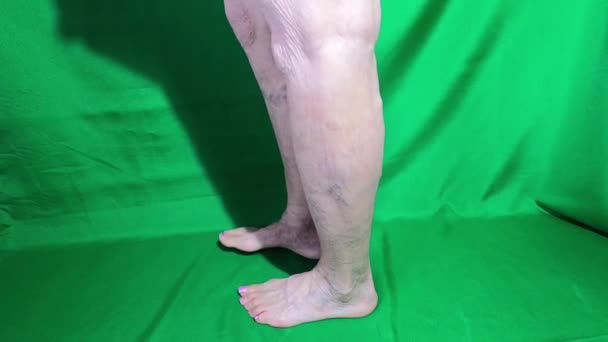 Vene varicose su una gamba anziana femminile da vicino - Filmati, video