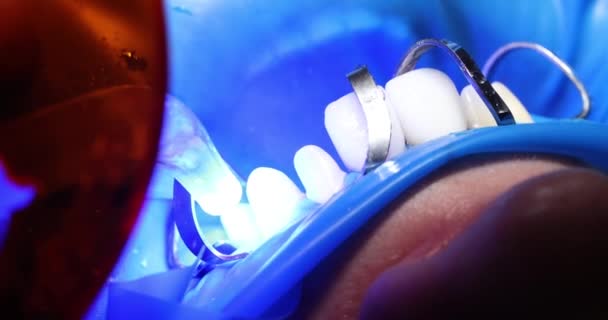 El dentista fija las carillas femeninas y las coronas de cerámica en los dientes usando una lámpara UV en la clínica dental. Tratamiento dental - Imágenes, Vídeo