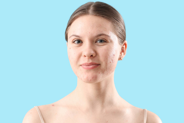 Nastolatka z problemem trądziku na niebieskim tle, zbliżenie - Zdjęcie, obraz