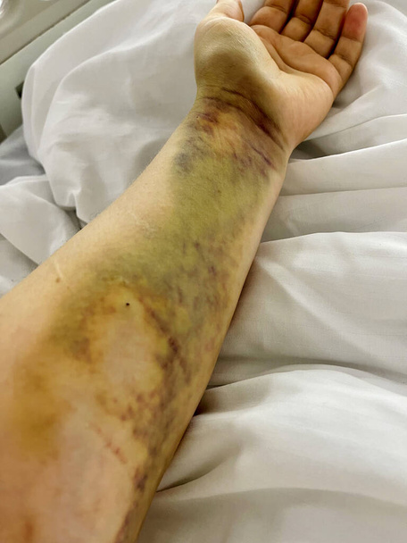 Рука с синяками и гематомой, пациент в реанимации в больнице - Фото, изображение