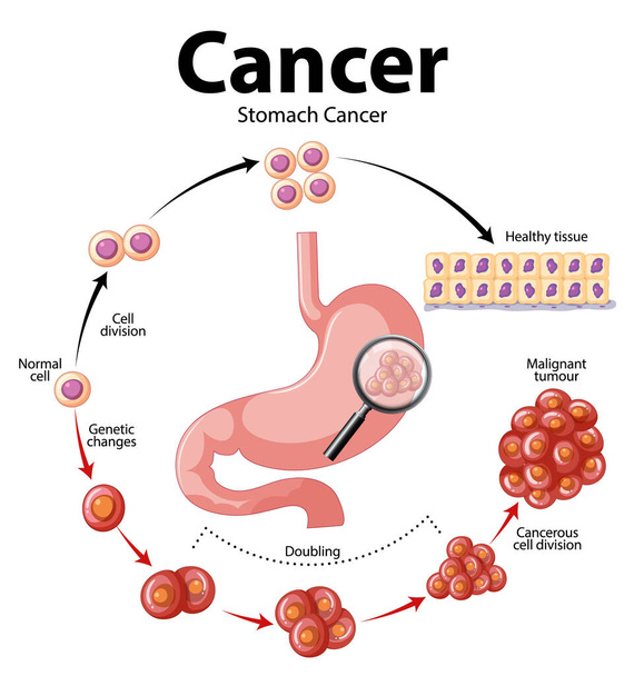 Illustrated infographic depicting abnormal cell growth in stomach cancer - Vector, Image
