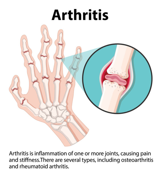 Lernen Sie die menschliche Anatomie und die Stadien der Arthritis durch eine informative Infografik kennen - Vektor, Bild