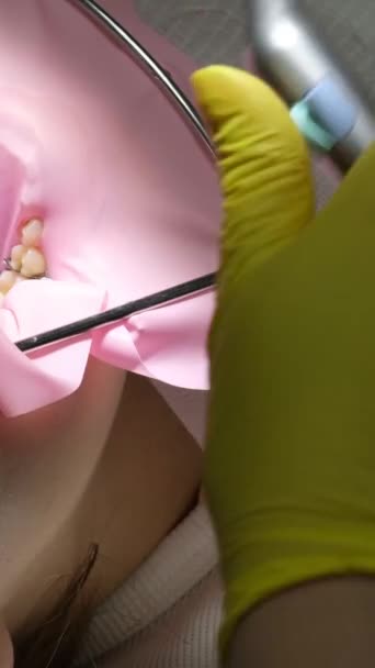 In der zahnmedizinischen Jugend füllt ein Arzt in gelben Handschuhen einen Zahn eines jungen Mädchens für ein Nahaufnahme-Video in der Zahnheilkunde beim Zahnarzt, der den Zahn mit leichten neuen Technologien trocknet. Moderne Klinik - Filmmaterial, Video