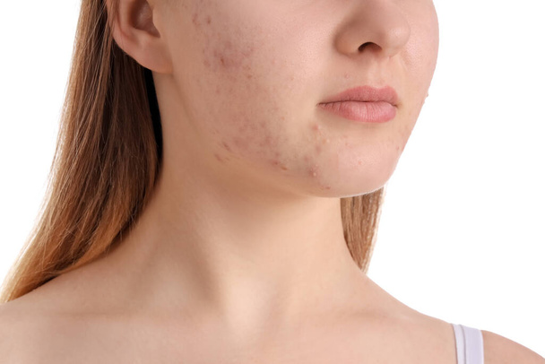 Adolescente avec problème d'acné sur fond blanc, gros plan
 - Photo, image