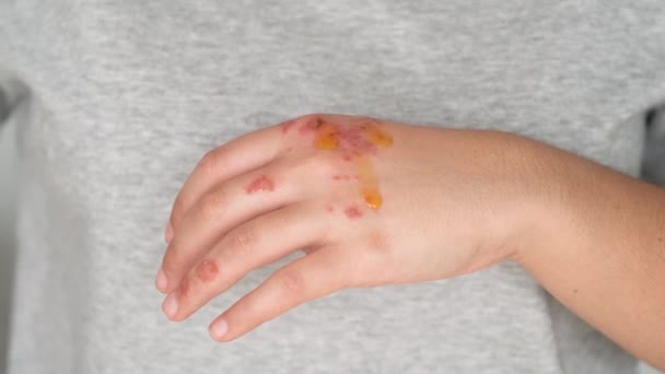 Ręce pacjenta nakładające olejek z róży na wyprysk. Zapalenie skóry, atopowe skóry naturalny środek. - Materiał filmowy, wideo