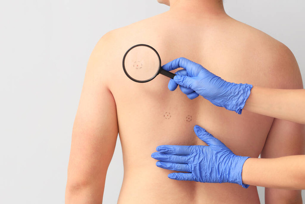 Dermatolog z lupą badający pieprzyki na plecach młodego człowieka na jasnym tle, zbliżenie - Zdjęcie, obraz