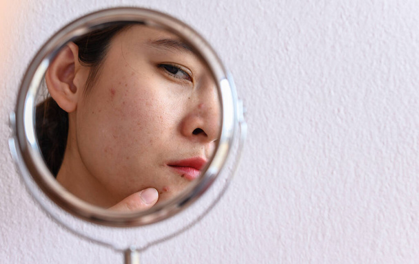 Gehakt shot van Aziatische vrouw zorgen te maken over haar gezicht toen ze zag het probleem van acne en litteken door de mini-spiegel. Conceptuele shot van acne en probleemhuid op vrouwelijk gezicht. - Foto, afbeelding