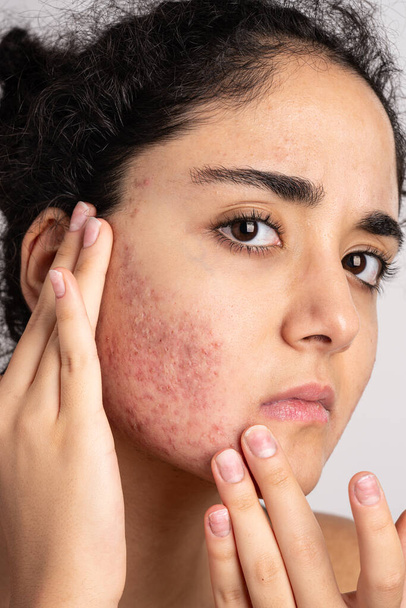 Acne on the young girl's face. Acne in teenage girl - Foto, imagen