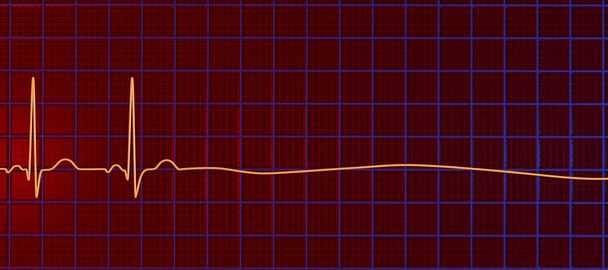 Asystol, kritický stav poznamenaný absencí jakékoliv srdeční elektrické aktivity. 3D ilustrace ukazuje rovinnou čáru na EKG, což znamená nefunkční srdce bez pulsu nebo tlukotu srdce. - Fotografie, Obrázek