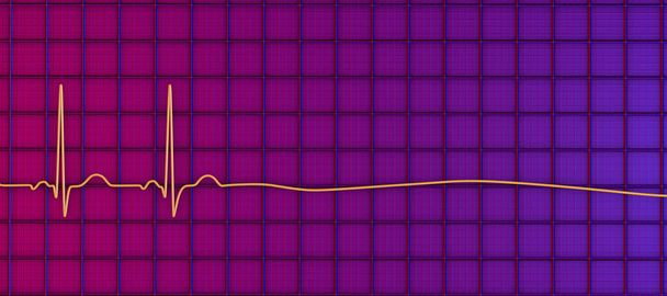 Asystole, ein kritischer Zustand, der durch das Fehlen jeglicher kardialer elektrischer Aktivität gekennzeichnet ist. 3D-Illustration zeigt eine flache Linie auf dem EKG, was auf ein nicht funktionierendes Herz ohne Puls oder Herzschlag hindeutet. - Foto, Bild