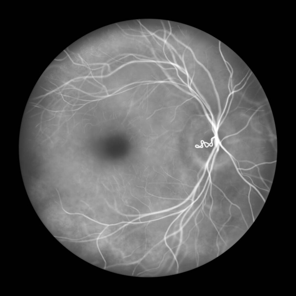 Eine präpapilläre Gefäßschleife auf der Netzhaut, wie sie bei der Ophthalmoskopie im Fluoreszein-Angiogramm beobachtet wurde, einer Illustration, die die sich schlängelnden Blutgefäße um die Papille herum zeigt. - Foto, Bild